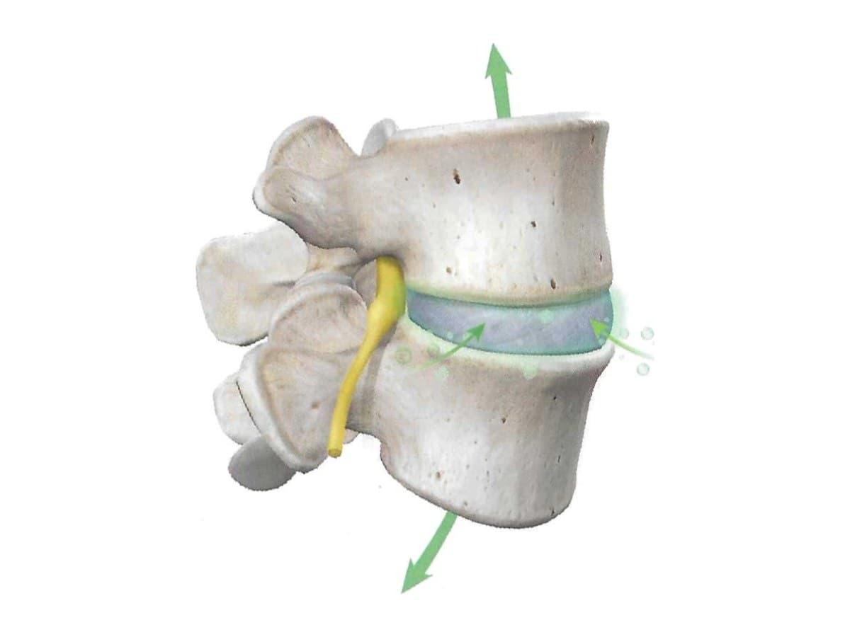 Illustration of a decompressed disc, with arrows showing the vertebrae drawing apart and fluid returning to the disc