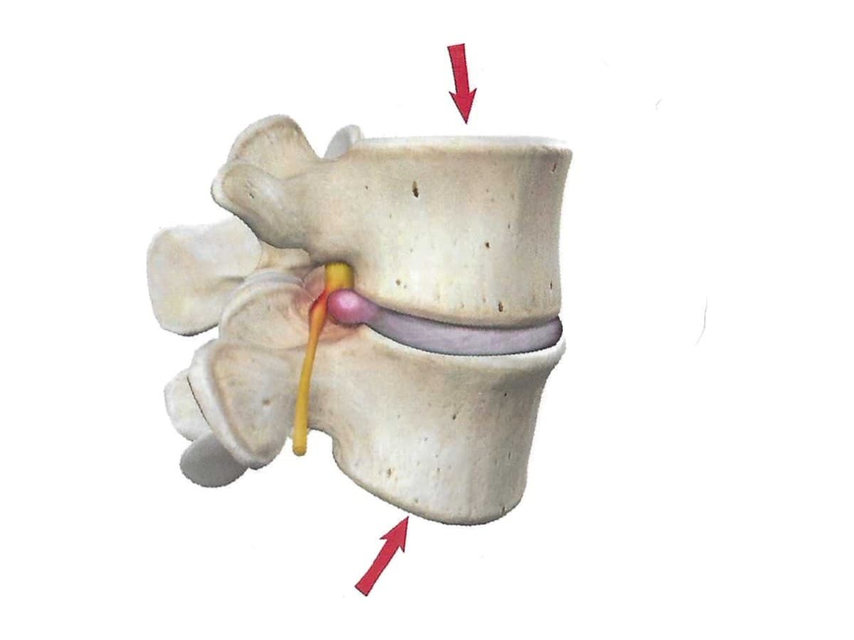 Illustration of a herniated disc, with arrows showing downward pressure squeezing the disc until it bulges into the spinal nerve